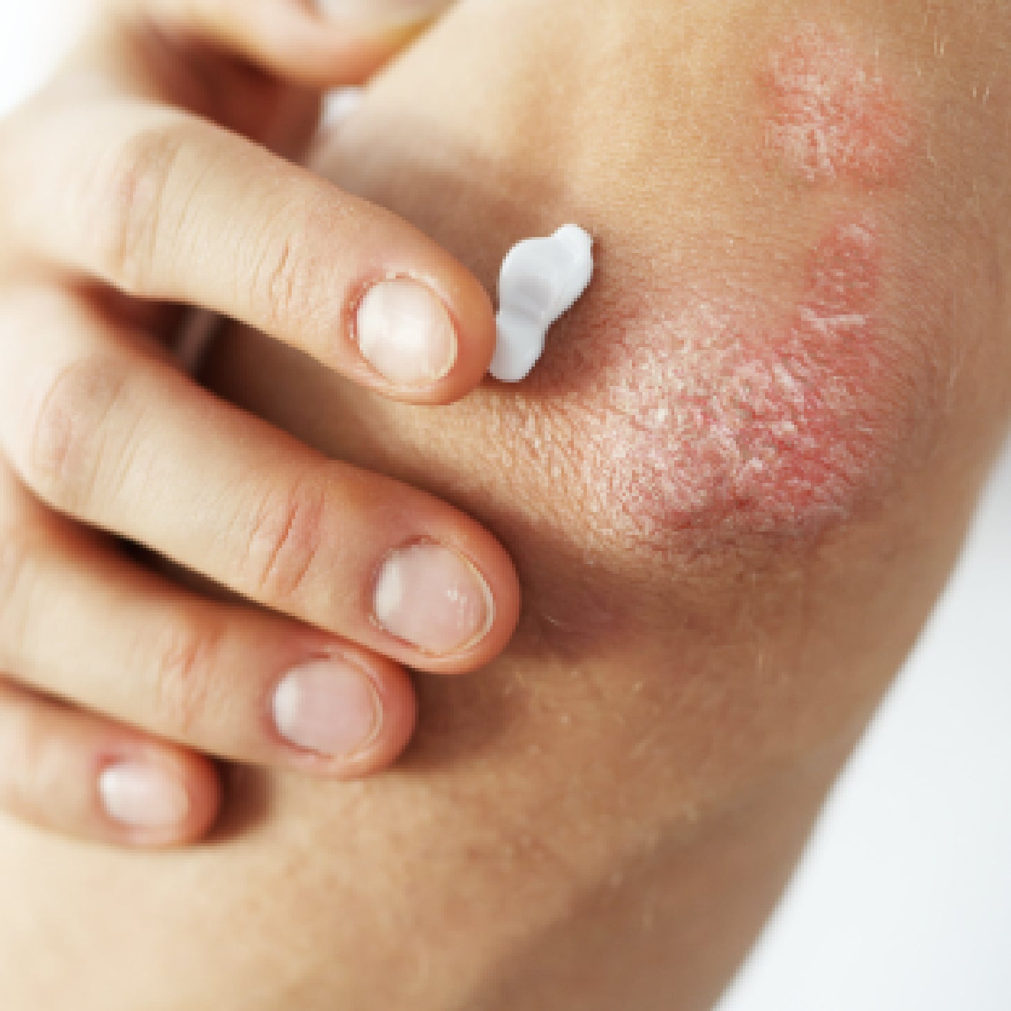 Kelo Cell Psoris Bálsamo SOS 30ml